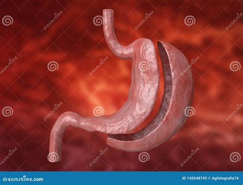 Vertical Sleeve Gastrectomy. Bariatric Surgery with Reduction of the Size of the Stomach for ...