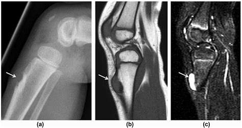 Tibial tuberosity lesions - Clinical Radiology
