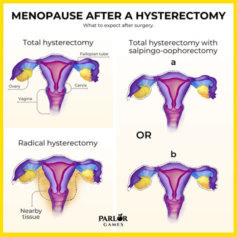 Menopause After Hysterectomy