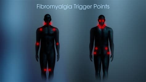 Picture Of Trigger Points For Fibromyalgia at Stephanie Slayton blog