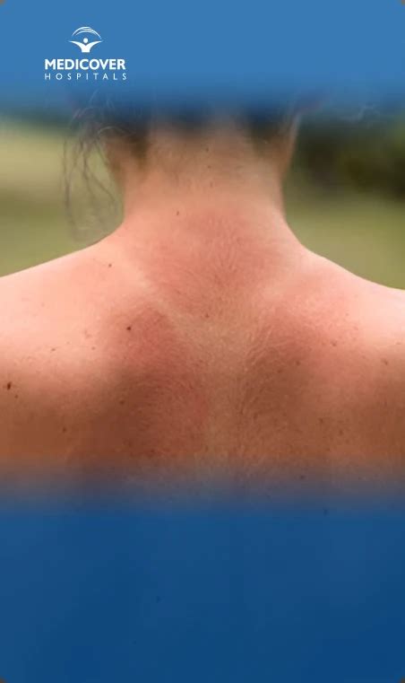 Sarpullido en el pecho y la espalda: causas comunes y tratamiento