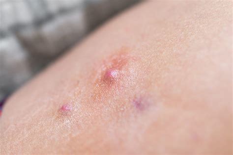 EADV 2025 Coverage: Incyte's Povorcitinib Improves Moderate-to-severe HS at Week 24 - The ...