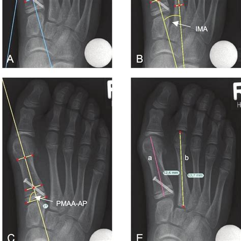 (PDF) Temporary screw epiphyseodesis of the first metatarsal for ...