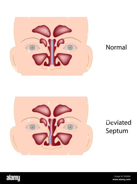 Deviated septum hi-res stock photography and images - Alamy