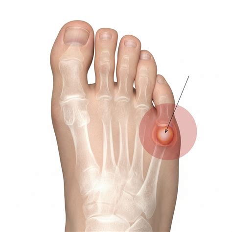 Juanete de Sastre: causas, síntomas y tratamiento