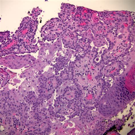 Squamous Cell Carcinoma In Situ Histology