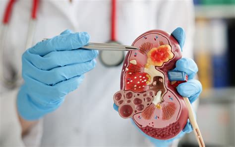 Ureteroscopy & Laser Lithotripsy | Kidney Stone Treatment at Z Urology