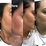 MELAGLOW Rich Depigmentation and Glow Restoration, Skin Brightening and ...