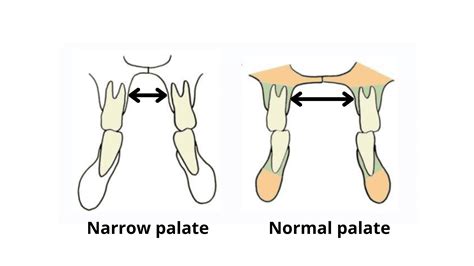 Palate Expander Can Change your Face! Here's how