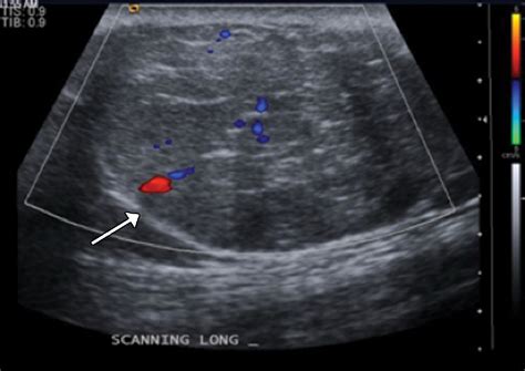 Imaging of Abdominal Wall Masses, Masslike Lesions, and Diffuse ProcessesRadioGraphics