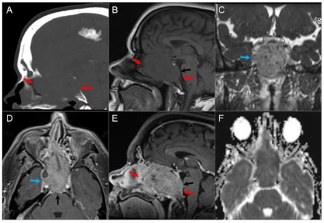 Imaging of Skull Base Tumors