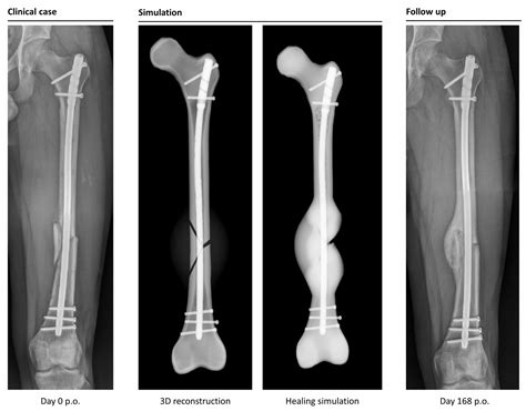 Computer-Based Mechanobiological Fracture Healing Model Predicts Non-Union of Surgically Treated ...