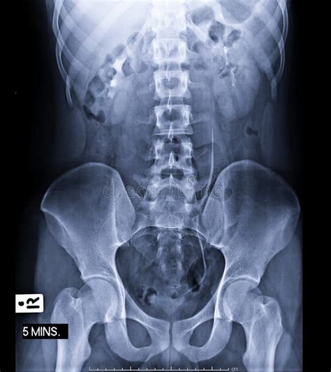 Image result for Normal Intravenous Pyelogram
