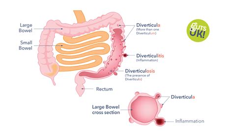 Diverticular Disease Awareness Week - Guts UK