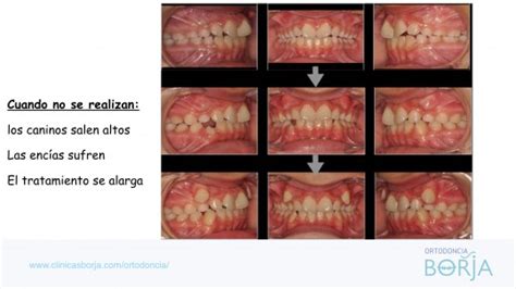 Ortodoncia Borja | Extracciones seriadas de dientes