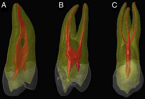Maxillary 1st Premolar