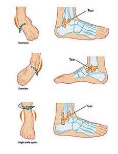 HOW LONG DOES A SPRAINED ANKLE TAKE TO HEAL 3 - Muscle Pull | Muscle Pull