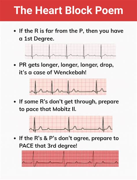 Heart Block Poem: Learning the Types Made Easy (2026)