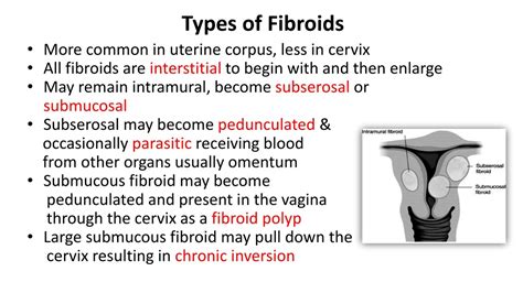 PPT - Uterine Fibroids PowerPoint Presentation, free download - ID:691513