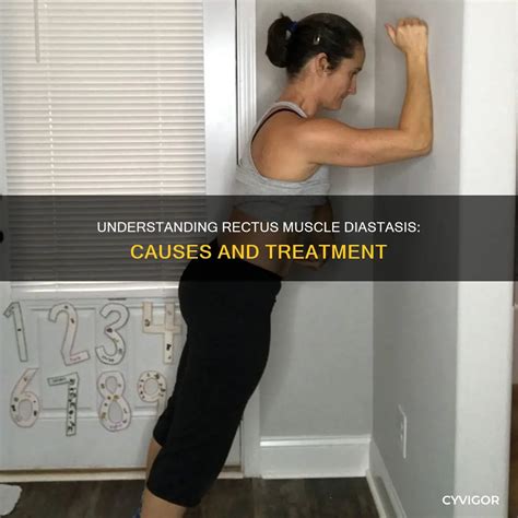 Understanding Rectus Muscle Diastasis: Causes And Treatment | CyVigor