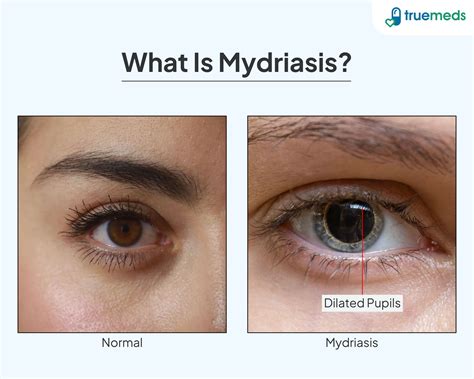 Mydriasis: Causes, Symptoms, Treatment & Prevention Guide