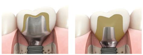 Radiological and Periodontal Evaluation of Stock and Custom CAD/CAM ...