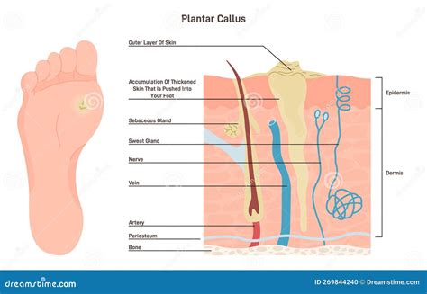 Feet Plantar Callus. Swollen Skin with Rough, Yellowing Patch of Lumpy ...