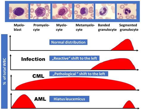 Definition, Epidemiology, Pathophysiology, and Essential Criteria for Diagnosis of Pediatric ...