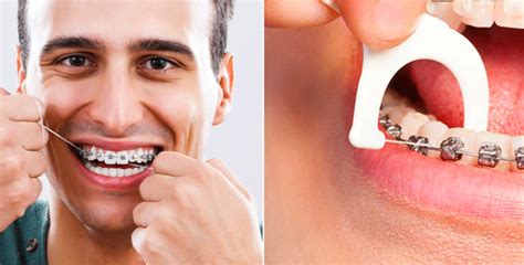 ब्रेसेससह फ्लॉस करण्याचे 4 मार्ग | Ways to Floss With Braces Info in ...
