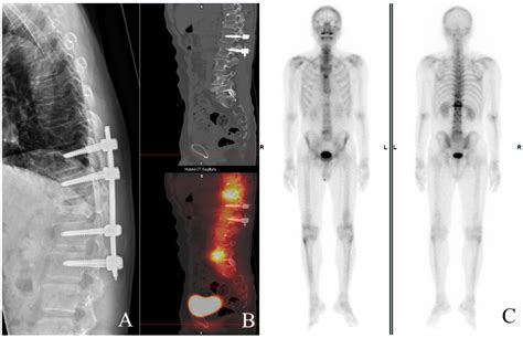Conus Medullaris And Cauda Equina Syndrome