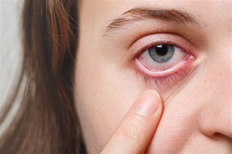 Bildergebnis für blepharitis ansteckend