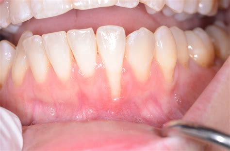 Gum Grafting Portland ME | Soft Tissue Grafting