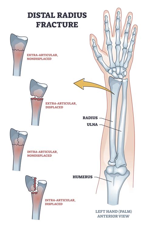 Classification Of Ulnar Fractures at Linda Philips blog