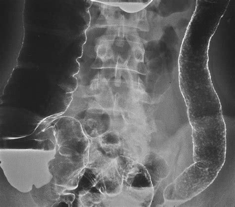 Bowel Wall Thickening