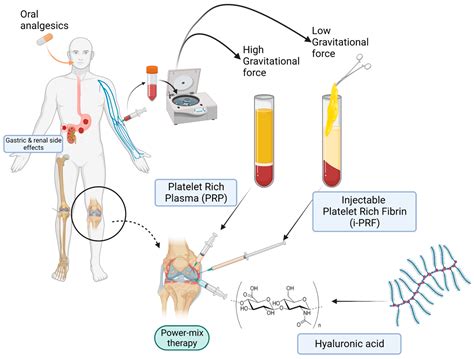 Platelet-Rich Plasma Power-Mix Gel (ppm)—An Orthobiologic Optimization ...