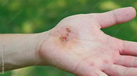 Image result for Exploding Orange Hand Injury