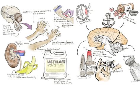 5 Pearls on Hepatic Encephalopathy – Core IM Podcast