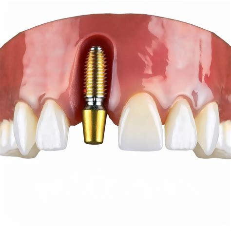 Single Tooth Dental implant
