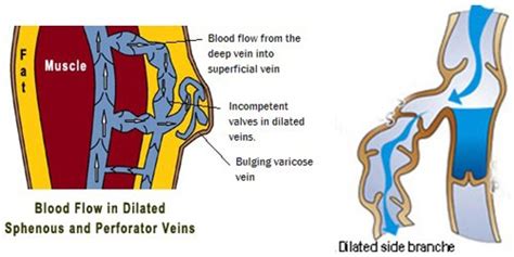Varicose Vein Treatment Dr. Pradeep Muley M.D. Senior Consultant ...