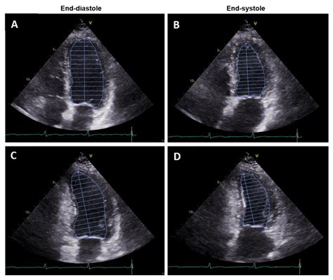 Non-Invasive Assessment of Left Ventricle Ejection Fraction: Where Do We Stand?