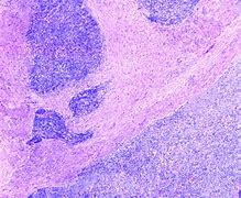 Image result for 肉瘤 Endometrial stromal sarcoma