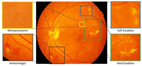 Indian Diabetic Retinopathy Image Dataset (IDRiD): A Database for ...