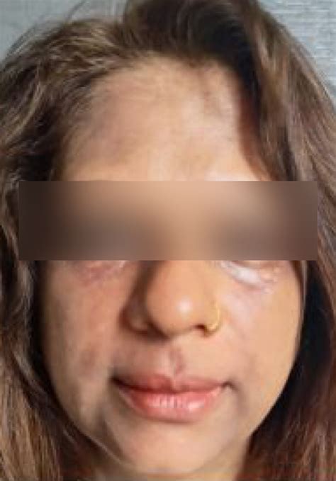 PRP Face Treatment for Skin Rejuvenation | Dermatrix