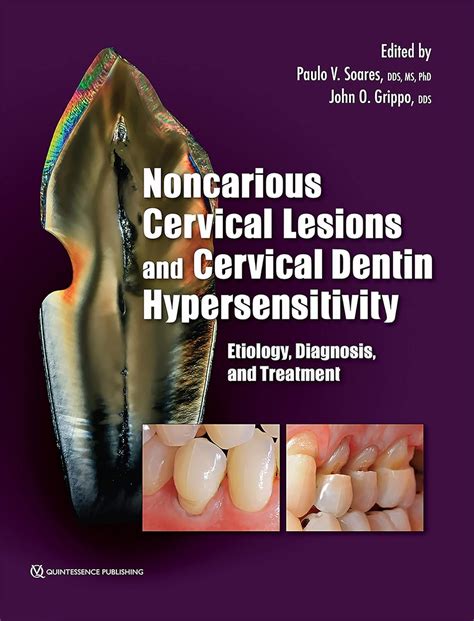 Noncarious Cervical Lesions and Cervical Dentin Hypersensitivity ...