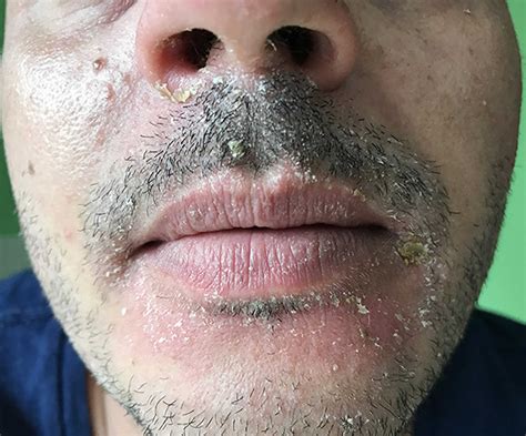 Seborrheic dermatitis, causes, symptoms, diagnosis, treatment & prognosis