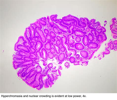 Pathology Outlines - Tubular adenoma