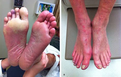 Peripheral Arterial Occlusive Diseases Vs