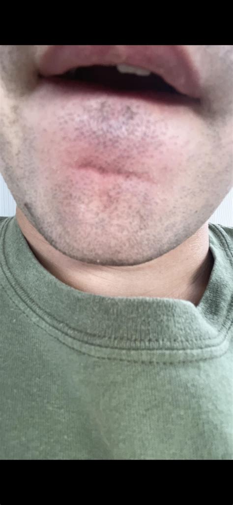 Rash in crease of chin for 6+ months : r/SebDerm
