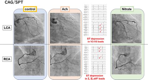 Epicardial Coronary Spasm in Left Anterior Descending Artery and ...