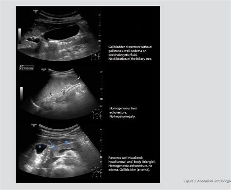 Fitz Hugh Curtis Ultrasound
